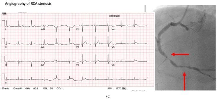 This composite diagnostic image illustrates a clinical case of coronary artery disease (CAD), specifically featuring a 12-lead electrocardiogram (ECG) and a corresponding coronary angiogram of the right coronary artery (RCA). The ECG portion displays a standard 12-lead layout (Leads I, II, III, aVR, aVL, aVF, and V1-V6) on a red grid background, showing rhythmic cardiac waveforms including identifiable P-waves, QRS complexes, and T-waves. The accompanying grayscale coronary angiogram provides radiographic visualization of the RCA. Two red arrows indicate significant focal narrowing, representing high-grade (>70%) stenosis in the vessel lumen. This comparison serves as an educational example of how clinical imaging (angiography) provides definitive evidence of obstructive CAD in a patient whose ECG findings are being analyzed for predictive modeling. The visual components emphasize the anatomical location of coronary lesions in the context of cardiovascular diagnostic workups.
