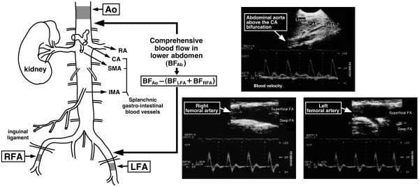 This composite educational graphic combines an anatomical line diagram and duplex ultrasound imaging to illustrate the methodology for calculating comprehensive lower abdominal blood flow (BFAb). The anatomical schematic depicts the abdominal aorta (Ao) and its primary branches, including the coeliac artery (CA), superior mesenteric artery (SMA), renal artery (RA), and inferior mesenteric artery (IMA). Shaded regions indicate Doppler measurement sites on the supra-coeliac aorta and the bilateral right and left femoral arteries (RFA, LFA) distal to the inguinal ligament. Three ultrasound panels provide B-mode anatomical views and pulsed-wave Doppler spectrograms. The abdominal aorta panel shows a sharp, pulsatile waveform with minimal reverse flow. In contrast, the RFA and LFA panels display classic triphasic arterial waveforms, characterized by a rapid systolic peak, early diastolic flow reversal, and a small late diastolic forward component. A mathematical formula defines BFAb as the difference between aortic blood flow and the sum of bilateral femoral arterial flow, representing total perfusion to the splanchnic, renal, and pelvic regions.