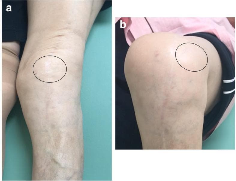 This composite of two clinical photographs illustrates dynamic patellar instability in a patient with a history of total knee arthroplasty (TKA). Image 'a' shows the left knee in a state of full extension. In this position, the patella (highlighted by a black circle) appears reduced and centered within the trochlear groove. Image 'b' demonstrates the same knee during flexion, where the patella (highlighted by a black circle) exhibits a clear lateral dislocation, moving out of its normal anatomical alignment toward the lateral aspect of the joint. Long surgical scars are visible on the anterior aspect of the knee and proximal tibia in both views, consistent with previous orthopedic procedures. Surface anatomy also reveals prominent venous vascularity in the lower leg and skin tension changes between extension and flexion. These findings are clinically characteristic of habitual patellar dislocation, often associated with component malalignment or soft tissue imbalance following knee replacement surgery.