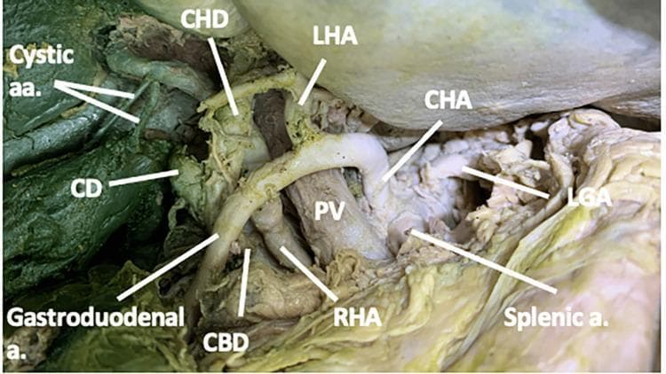 This clinical anatomical photograph displays a dissected hepatobiliary region and the celiac trunk branches in a cadaveric specimen. The image demonstrates the complex spatial relationships within the cystohepatic triangle (Calot's triangle). Centrally, the portal vein (PV) is visible, with the common hepatic artery (CHA) branching into the left hepatic artery (LHA) and gastroduodenal artery (a.). A significant anatomical variation is shown where the right hepatic artery (RHA) courses deep to the gastroduodenal artery and the common hepatic duct (CHD). The RHA is seen positioned between the portal vein and the common bile duct (CBD). Additionally, two cystic arteries (Cystic aa.) are identified originating from the RHA near the junction of the cystic duct (CD) and CHD. Other visible vascular structures include the splenic artery and the left gastric artery (LGA). This visual is intended for surgical education, specifically for understanding vascular and ductal variations during cholecystectomy or hepatobiliary surgery.
