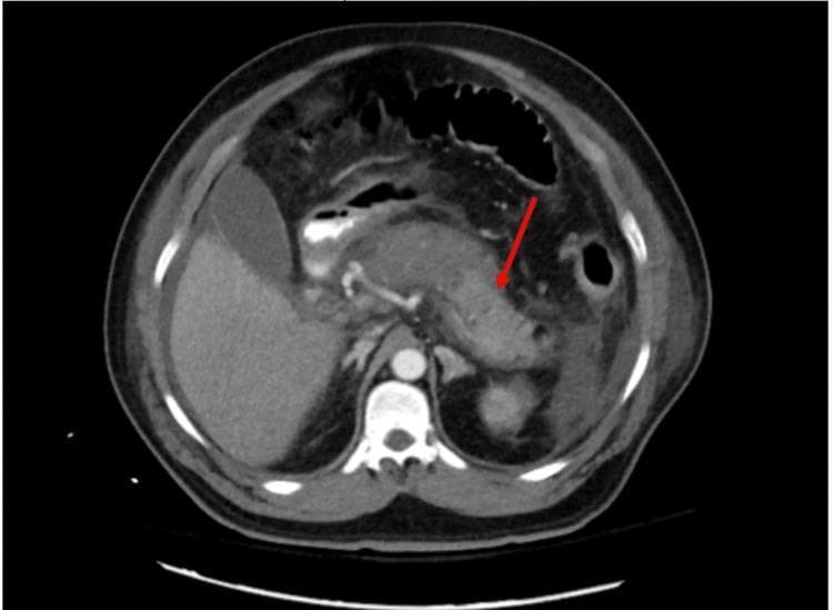 This diagnostic image is an axial contrast-enhanced Computed Tomography (CT) scan of the upper abdomen, primarily demonstrating severe acute necrotizing pancreatitis. The pancreas is significantly enlarged and edematous, showing heterogeneous enhancement. A red arrow points to non-enhancing, hypodense regions within the pancreatic parenchyma, particularly involving the body and tail, which are consistent with pancreatic necrosis. There is also evidence of peripancreatic fat stranding and fluid accumulation, indicating a severe inflammatory process. Surrounding anatomical structures are visible, including the liver (right), spleen (left), and cross-section of the spine and aorta. The image serves as a clinical illustration of advanced acute pancreatitis with parenchymal destruction, highlighting the importance of contrast-enhanced imaging in evaluating the extent of glandular necrosis for clinical staging and management decisions.