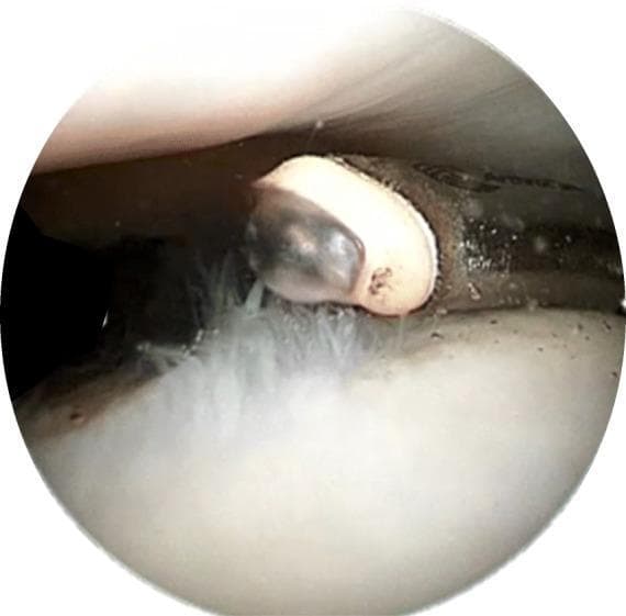 This clinical photograph is an intraoperative arthroscopic view demonstrating the use of a Coblation (controlled ablation) wand on articular cartilage within a human joint, likely the knee. The image shows the distal tip of the Coblation device, characterized by a light-beige ceramic insulator and a dark metallic electrode. A distinctive, semi-transparent dome-shaped plasma layer is visible at the working end of the wand, illustrating the radiofrequency-excited field used to dissolve tissue. The wand is in close proximity to a white, pearlescent cartilaginous surface. Visible pathology includes fine, filamentous white structures representing chondral fibrillation, typical of Grade 2 or 3 chondromalacia. The educational focus is the visualization of the plasma-mediated debridement process (chondroplasty), where the device is used to smooth frayed articular surfaces while minimizing thermal damage to underlying healthy chondrocytes and the extracellular matrix. This procedural image is highly relevant for orthopedic surgical training and sports medicine education regarding joint preservation techniques.