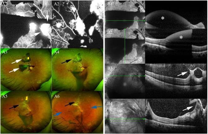 This composite multimodal imaging series documents the progression of proliferative diabetic retinopathy (PDR) and the evolution of preretinal hemorrhage. The panel includes Fundus Fluorescein Angiography (FFA), color fundus photography (A1–A6), and Optical Coherence Tomography (OCT) (B1–B4). Initial FFA (A1, A2) identifies extensive non-perfusion areas and active neovascularization. Early fundus images (A1, A3) show dense preretinal hemorrhage obscuring the optic disc. Serial images (A4–A6) demonstrate the progression of fibrovascular proliferation (black arrows) following hemorrhage drainage. A6 reveals a detached posterior hyaloid appearing as a clear elliptic boundary (blue arrows). Corresponding OCT scans (B1, B2) visualize the dense preretinal hemorrhage as a highly reflective, dome-shaped mass beneath the internal limiting membrane (ILM) or within the sub-hyaloid space (asterisks). Longitudinal OCT follow-up (B3, B4) highlights the development of secondary fibrovascular traction (white arrows) and thickening of the preretinal membranes as the hemorrhage resolves. This case illustrates the clinical progression from acute vitreous/preretinal hemorrhage to severe proliferative changes and vitreoretinal traction in a patient with diabetic retinopathy.