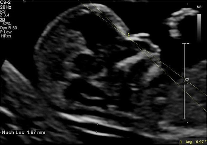 This diagnostic ultrasound image shows a mid-sagittal section of a fetus at 13 weeks and 2 days of gestation. The primary educational focus is the measurement of the Maxilla-Nasion-Mandible (MNM) angle, a clinical marker used in first-trimester screening to evaluate facial profiles and detect potential anomalies like micrognathia or retrognathia. The image displays two intersecting dotted lines originating from the nasion (the junction of the frontal and nasal bones), with one line extending along the maxilla and the other along the mandible, resulting in a measured angle of 6.97 degrees. Additionally, a Nuchal Translucency (NT) measurement of 1.87 mm is visible in the lower left, indicating a normal range for this gestational age. Key anatomical landmarks visible include the fetal forehead, nasal bone, maxilla, mandible, and the fluid-filled space at the back of the neck. This image serves as a reference for normal fetal craniofacial development in obstetrics and prenatal diagnostics.