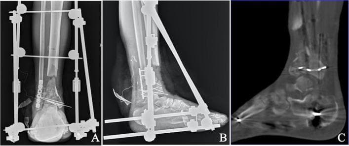 This composite medical image displays postoperative diagnostic studies of a complex distal tibia fracture, specifically a type C3.3 pilon fracture with significant bone loss. Panels A and B provide anteroposterior (AP) and lateral X-ray views showing a large, 6 cm segmental defect in the distal tibial metaphysis following debridement and bone resection. The limb is stabilized by a spanning triangular external fixator involving the tibia and foot. Internal fixation is visible at the distal articular surface, consisting of multiple Kirschner wires (K-wires) and a lateral fibular plate with screws to maintain the distal syndesmosis and fibular length. Panel C presents a sagittal computed tomography (CT) reconstruction of the ankle joint, demonstrating successful articular reduction. The CT confirms joint surface congruence with minimal displacement, specifically showing a step-off or gap of less than 2 mm. These images illustrate the first stage of a multi-stage surgical protocol for treating high-energy open fractures, focusing on debridement, joint reconstruction, and temporary stabilization before secondary bone transport procedures.