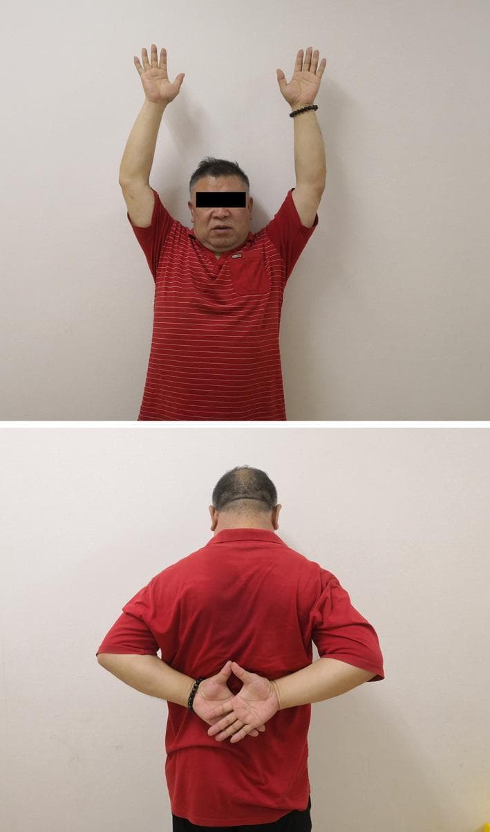 This clinical photograph consists of two panels illustrating the postoperative functional outcome and range of motion (ROM) in a patient following surgical repair of an acromioclavicular joint (ACJ) dislocation. The upper panel shows an anterior view of the patient demonstrating full bilateral shoulder abduction and flexion with both arms raised symmetrically overhead. The elbows are in full extension, and the hands are open with fingers extended, indicating unimpaired upward mobility. The lower panel shows a posterior view of the patient demonstrating internal rotation and adduction of the shoulders. The patient has successfully placed both hands behind the back with the fingers interlaced, a position often used in the Apley Scratch Test to assess functional internal rotation. The images highlight the successful restoration of joint stability and mobility after double‐loaded suture anchor reconstruction of the coracoclavicular (CC) ligaments and ACJ augmentation, showing no evidence of residual pain or mechanical restriction during these movements.