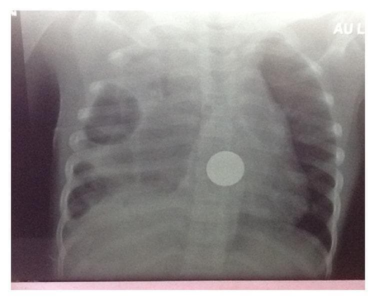 Anteroposterior (AP) chest radiograph of a pediatric patient demonstrating significant pulmonary and esophageal pathology. The right lung field exhibits extensive opacification and increased density with visible loculation, consistent with a complex empyema secondary to esophageal perforation. In contrast, the left lung field shows relatively normal aeration with preserved lung markings. Centrally, located slightly to the right of the midline at the level of the mid-thoracic spine, is a distinct, highly radiopaque, circular foreign body. The morphology and location of the object are characteristic of an ingested coin impacted in the esophagus. The mediastinal structures appear obscured by the adjacent right-sided pleural disease. This image serves as a critical diagnostic example of the secondary complications of esophageal foreign body impaction, specifically mediastinitis and loculated empyema in a clinical setting.