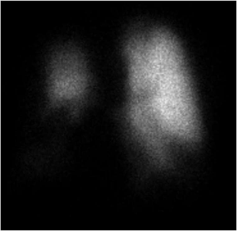 This diagnostic image is a nuclear medicine perfusion scan of the lungs in an anterior projection. The scan demonstrates a significant disparity in pulmonary blood flow distribution. The left lung exhibits relatively uniform and intense tracer uptake across its upper, middle, and lower zones. In contrast, the right lung shows marked perfusion defects, particularly localized to the right middle and right lower lobe regions. In these areas, the perfusion signal is significantly attenuated or absent compared to the right upper lobe and the entire left lung. Such findings are clinically consistent with severe vascular obstruction, such as that caused by fibrosing mediastinitis-induced pulmonary artery stenosis. This visual evidence serves as a critical educational example of how anatomical compression of the pulmonary vasculature results in segmental or lobar perfusion deficits, visible on V/Q scintigraphy, which can contribute to the development of precapillary pulmonary hypertension.