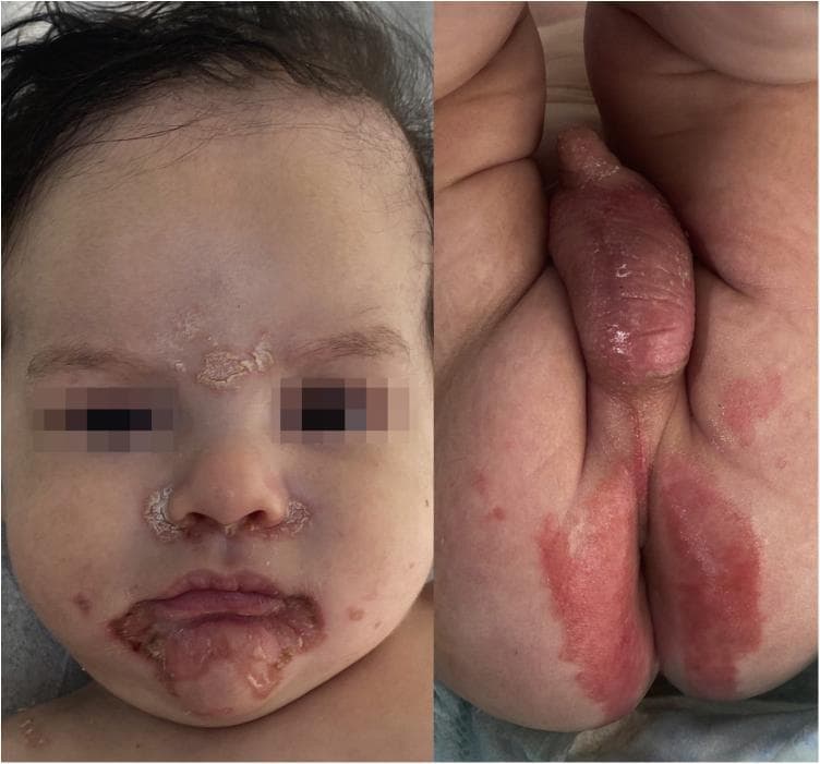 Clinical photograph of an infant presenting with classic dermatological manifestations of zinc deficiency, such as acrodermatitis enteropathica or transient neonatal zinc deficiency. The image is split into two panels. The left panel shows the patient's face with characteristic erythematous, desquamative, and crusted lesions in a symetrical distribution. Primary areas of involvement include the perioral region (surrounding the lips), the perinasal area (alar base and nasolabial folds), and the glabella (interbrow region). The right panel displays the diaper area, showing well-demarcated, bright red erythematous patches and desquamation across the scrotum, penis, and perineal/perianal regions. The overall clinical presentation highlights the classic 'periorificial' distribution of skin lesions typical of nutritional or genetic zinc metabolism disorders. These findings are pedagogically significant for distinguishing nutritional deficiencies from common diaper dermatitis or atopic eczema in pediatric patients.
