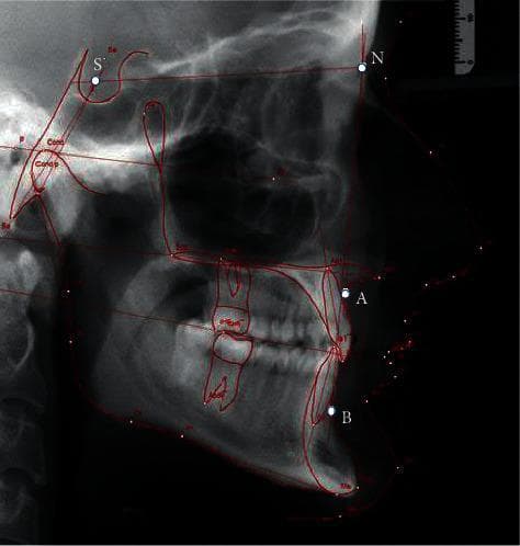 This diagnostic image is a lateral cephalogram, a standardized orthodontic X-ray providing a sagittal view of the human skull, facial bones, and soft tissue profile. The radiography demonstrates key anatomical landmarks used in cephalometric analysis. Traced in red are skeletal outlines including the cranial base, sella turcica, maxilla, and mandible. Specific cephalometric points are highlighted: S (Sella), N (Nasion), A (Subspinale), and B (Supramentale). These points facilitate the measurement of angles such as SNA, SNB, and ANB to evaluate the anteroposterior relationship of the jaws and determine facial types (orthognathic, retrognathic, or prognathic). The image clearly depicts the dentition, showing the inclination of the maxillary and mandibular incisors relative to their respective basal bones. This clinical tool is essential for orthodontic diagnosis, treatment planning for malocclusions, and assessing craniofacial growth or surgical outcomes in maxillofacial procedures.