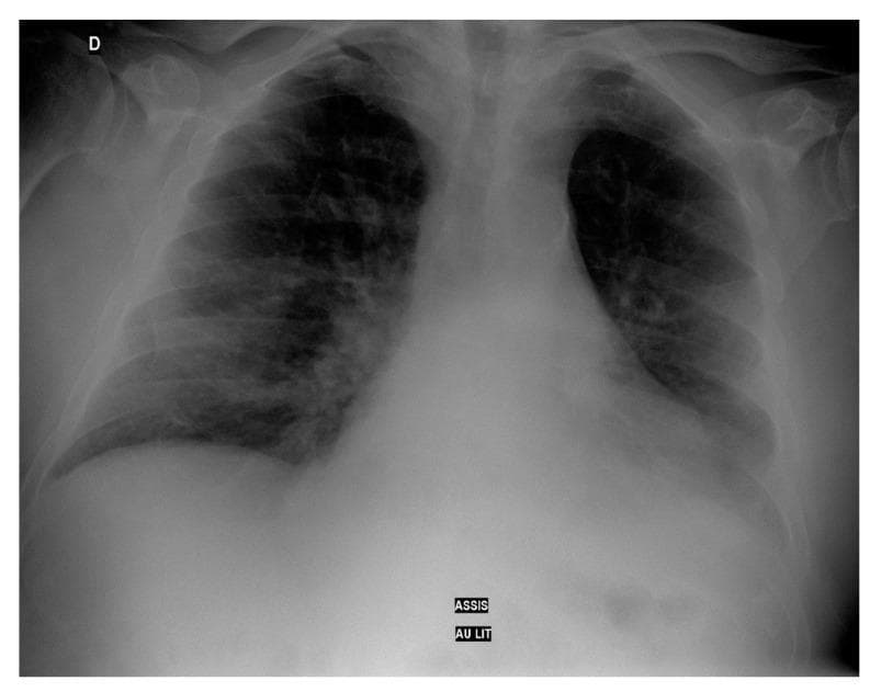 This diagnostic image is a frontoposterior thoracic radiograph (chest X-ray) of an adult patient. The radiograph demonstrates diffuse, bilateral pulmonary opacities characterized by a mixed alveolar and interstitial pattern. These findings are consistent with widespread lung inflammation or damage, as seen in cases of severe pneumonia or Acute Respiratory Distress Syndrome (ARDS). The distribution is globally increased in density, but there is a notable concentration of opacity in the left lung base, suggestive of focal consolidation or a small pleural effusion. The cardiac silhouette appears within normal limits, though partially obscured by the adjacent pulmonary opacities. The costophrenic angle on the right is relatively clear compared to the obscured left base. Educational focus includes the recognition of bilateral lung infiltrates and the differentiation between diffuse interstitial patterns and localized consolidation in a clinical context of respiratory distress.