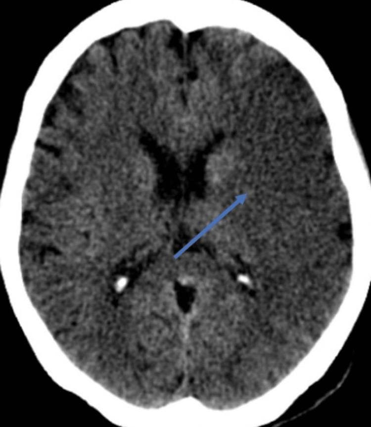 This diagnostic image is an axial non-contrast computed tomography (CT) scan of the brain. The scan reveals a localized area of hyperdensity within the left cerebral hemisphere, specifically involving the region of the basal ganglia or internal capsule, indicated by a blue arrow. The hyperdense lesion is roughly ovoid in shape and appears brighter than the adjacent normal gray and white matter parenchyma. The surrounding ventricular system, including the frontal horns of the lateral ventricles and the third ventricle, appears relatively symmetrical without significant midline shift or mass effect. The cortical sulci are visible but show mild effacement in the left hemisphere compared to the right, suggesting localized edema. This finding is clinically significant for acute cerebrovascular events, such as a hemorrhagic transformation of an ischemic stroke or a primary intracerebral hemorrhage. The image serves as a teaching tool for recognizing density changes in neuroimaging and understanding the vascular anatomy of the middle cerebral artery territory.