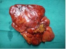 Clinical photograph showing a gross specimen of primary omental torsion (POT) resting on a surgical drape. The image demonstrates a resected portion of the greater omentum with clear evidence of vascular compromise and infarction. Proximal to the torsion point, the omentum appears relatively normal; however, distal to the twist, the tissue is severely congested, thickened, and displays a characteristic cyanotic, reddish-purple hue indicative of hemorrhagic infarction. The specimen has a lobulated architecture, with focal yellowish areas suggestive of fat necrosis. This visual illustrates the pathophysiological results of mechanical torsion on adipose peritoneal tissue, leading to venous obstruction and subsequent tissue ischemia. It serves as a classic educational example of an acute abdominal condition requiring surgical intervention (omentectomy).