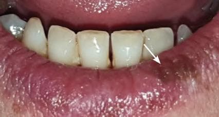This clinical photograph displays an intraoral view of the lower lip and mandibular anterior teeth, highlighting a localized pathological lesion. The primary finding is a well-defined, crusted lesion located on the lower left lip along the vermillion border, specifically toward the commissure. The lesion exhibits a dark brownish-black coloration with a rough, uneven, and thickened texture, consistent with a dried serosanguinous crust. The surrounding labial mucosa and vermillion show generalized erythema, edematous swelling, and prominent vertical tissue folds, indicating an underlying inflammatory process. This presentation is characteristic of a late-stage Herpes labialis outbreak (cold sore) during the crusting phase. The image serves as a teaching tool for recognizing common viral orofacial infections, focusing on the distribution, morphology, and clinical evolution of herpetic lesions in a dental or dermatological context.