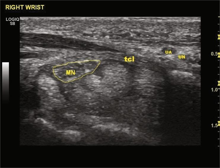 This diagnostic grayscale ultrasound image displays a transverse cross-section of the right volar wrist, specifically detailing the carpal tunnel anatomy for preoperative planning. The median nerve (MN) is identified within a yellow outline, presenting with a characteristic honeycomb-like appearance and hypoechoic echogenicity relative to the surrounding fascia. Superior to the carpal tunnel contents, the transverse carpal ligament (TCL) is labeled, appearing as a heterogeneous, hyperechoic band. Medial to the TCL and median nerve (on the right side of the image), the ulnar artery (UA) is visible as an anechoic circular structure, adjacent to the ulnar nerve (UN). The image demonstrates the spatial relationships between these neurovascular structures, which is critical for establishing a 'safe zone' during minimally invasive procedures like thread carpal tunnel release (TCTR). Key anatomical landmarks including the flexor tendons and bony boundaries are visible in the background with varying echogenicity.