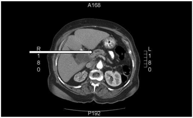 This diagnostic image is an axial contrast-enhanced CT scan of the abdomen at the level of the pancreatic head. The scan demonstrates a significant pathological finding in the pancreatic region: an ill-defined, hypo-attenuating mass located at the head of the pancreas, indicated by a horizontal white arrow. This lesion causes an abrupt ductal cutoff, resulting in secondary dilatation of the proximal biliary tree and the main pancreatic duct (the 'double duct sign'). Surrounding anatomical structures are clearly visible, including the liver in the right upper quadrant, the spleen in the left upper quadrant, and both kidneys in the retroperitoneal space posteriorly. The stomach and bowel loops are seen centrally and anteriorly. This imaging pattern is highly characteristic of pancreatic ductal adenocarcinoma (PDAC) causing obstructive jaundice. The scan is intended for intermediate to advanced medical learners to illustrate the radiological presentation of distal biliary obstruction and pancreatic malignancy.
