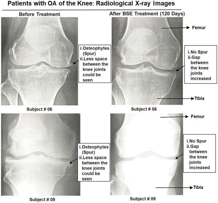 This diagnostic image is a comparison chart featuring anteroposterior (AP) X-ray radiographs of the knee joints from two patients (Subject #06 and Subject #09) diagnosed with osteoarthritis. The figure is organized into two columns: 'Before Treatment' and 'After BSE Treatment (120 Days).' In the 'Before Treatment' images, radiological signs of osteoarthritis are evident, including visible marginal osteophytes (bone spurs) at the joint edges and significant narrowing of the joint space between the femur and tibia. The 'After BSE Treatment' images illustrate the results of Boswellia serrata extract (BSE) therapy, showing a notable reduction or absence of the previously noted osteophytes and a visible increase in the joint space gap. The images are annotated with arrows identifying the femur and tibia, along with descriptive text boxes highlighting the increase in joint gap and the disappearance of spurs post-treatment. This comparison serves as a clinical illustration of potential radiological improvement in osteoarthritic knee conditions following anti-inflammatory pharmacological intervention.