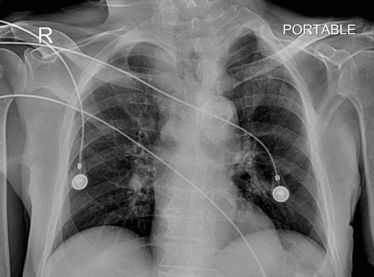 Anterior-posterior (AP) portable chest radiograph. The image depicts the thoracic cage, including the ribs, clavicles, scapulae, and thoracic spine. A right-side marker ('R') and 'PORTABLE' label are visible. The central mediastinal silhouette, including the heart and great vessels, appears within normal limits for this projection. The trachea is centrally located and patent, visible as a radiolucent column extending toward the carina. The lung parenchyma shows bilateral pulmonary vascular markings without clear evidence of consolidation or large pleural effusions. Several external medical monitoring devices are present: multiple radiopaque ECG leads and two circular cutaneous electrode pads are positioned over the chest wall. The radiograph is used clinically to confirm tracheal patency and assess for complications like aspiration pneumonia in patients with chronic dysphagia and instrumentation. The educational focus is on the interpretation of a standard follow-up bedside chest X-ray and identifying normal airway anatomy and medical monitoring hardware.