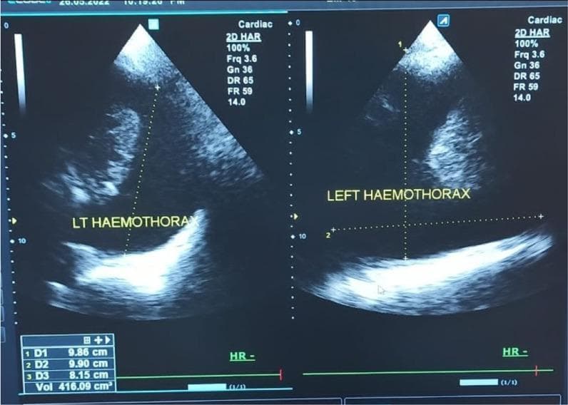This diagnostic image displays a split-screen B-mode ultrasound of a left hemothorax in a 30-year-old male. The scan, performed using a cardiac preset and harmonic imaging (2D HAR) at 3.6 MHz, shows a large anechoic to hypoechoic fluid collection in the pleural space, consistent with blood accumulation. The fluid collection demonstrates heterogeneous internal echotexture. Superior to the fluid, the lung appears as a consolidated, hyperechoic structure floating within the effusion. Dotted caliper lines indicate volumetric measurements (D1, D2, D3), with a calculated volume of approximately 416.09 cm³. The image demonstrates clinical utility in the eFAST (Extended Focused Assessment with Sonography for Trauma) protocol for identifying pleural effusions and hemothorax. Key ultrasound parameters are visible on the right sidebar, including a dynamic range (DR) of 65 and a frame rate (FR) of 59, optimized for high-contrast thoracic imaging.