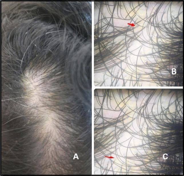 This composite image illustrates the clinical and dermoscopic presentation of seborrheic dermatitis on the scalp. Image A is a clinical photograph showing the mid-frontal scalp of a patient with visible diffuse, fine, white-to-yellowish scaling. Despite the scaling, the hair density and shaft structure appear relatively preserved. Images B and C are dermoscopic views of the same region, providing a magnified perspective of the scalp surface. They reveal characteristic yellowish, greasy scales (indicated by red arrows) distributed inter-follicularly among the hair shafts. The hair follicles themselves do not show significant atrophy or scarring. These findings are typical for seborrheic dermatitis, differentiating it from other inflammatory scalp conditions. This visual material is intended for dermatology education to assist in the identification of inflammatory scalp disorders and the application of dermoscopy in clinical diagnosis.