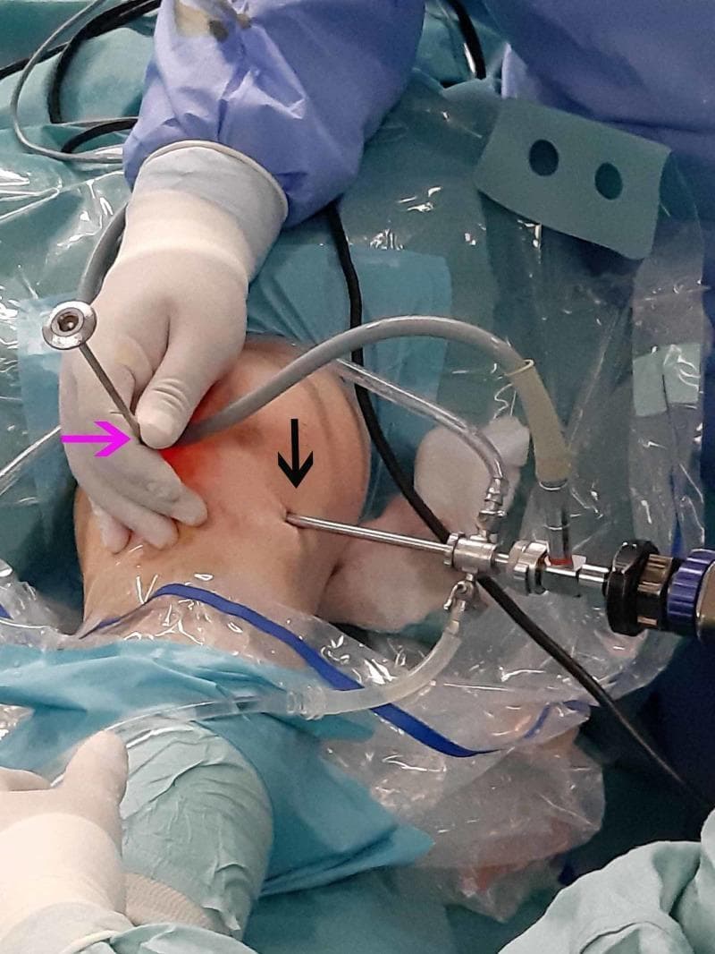 Clinical photograph of a knee arthroscopy procedure in an operating room environment. The image demonstrates standard surgical positioning, sterile draping with clear adhesive barriers, and instrumentation. Two primary surgical portals are identified: a pink arrow indicates the anteromedial portal where a blunt trocar is being manipulated by a gloved hand, and a black arrow indicates the anterolateral portal containing an arthroscope sheath equipped with light source cables and fluid irrigation tubing. The knee joint is distended, suggesting active fluid irrigation for visualization. The surrounding field is prepared with blue sterile drapes and the surgical team is wearing appropriate sterile attire. This image illustrates the external setup and portal placement necessary for intra-articular orthopedic interventions, specifically used here for the visualization and localization of an infrapatellar tumor.