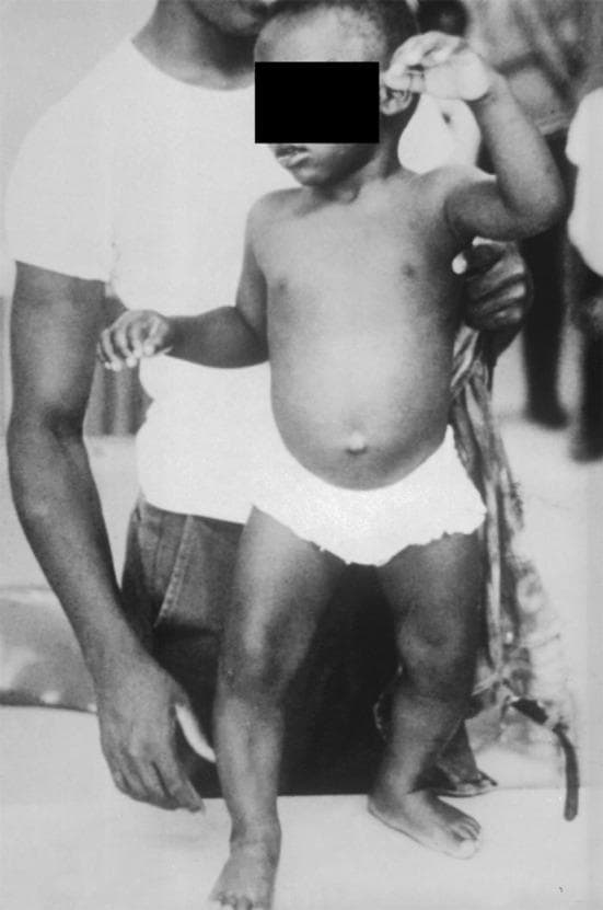 This clinical photograph displays the classic musculoskeletal manifestations of vitamin D deficiency rickets in a young child. The most prominent feature is significant genu varum (bowing of the legs), where the weight-bearing long bones show lateral curvature due to impaired mineralization of the growth plate and osteoid matrix. Additionally, the child exhibits a distended abdomen (potbelly), which is a common clinical sign associated with rickets due to hypotonia of the abdominal muscles. The upper extremities appear thin, suggesting poor muscle development or nutritional deficiency. This archival image serves as a pedagogical tool for identifying systemic skeletal deformities resulting from metabolic bone disease. Key educational concepts include the relationship between vitamin D deficiency, calcium homeostasis, and the softening of bones (osteomalacia) during childhood development. The clinical relevance extends to pediatrics, endocrinology, and public health nutrition.
