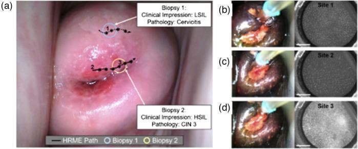 A multi-panel clinical and diagnostic figure demonstrating cervical cancer screening via multimodal colposcopy and high-resolution microendoscopy (HRME). (a) Macroscopic clinical photograph of the cervix following acetic acid application. The image displays a central area of acetowhite epithelium and hyperemic regions near the cervical os. Annotated features include an 'HRME Path' (dashed line) and two biopsy locations: Biopsy 1 (clinical impression of LSIL; pathology: Cervicitis) and Biopsy 2 (clinical impression of HSIL; pathology: CIN 3). (b, c, d) Sequential pairs of macroscopic cervical images and corresponding proflavine-stained HRME fluorescence micro-images from three distinct sites. 'Site 1' and 'Site 2' show dense, uniformly distributed punctate nuclei typical of low-grade or normal tissue. 'Site 3' (associated with HSIL/CIN 3) demonstrates altered nuclear morphology and distribution, characterized by increased nuclear-to-cytoplasmic ratios and disordered cellular arrangement. This figure illustrates the integration of wide-field colposcopy with point-of-care fluorescence microendoscopy for localized diagnostic validation.