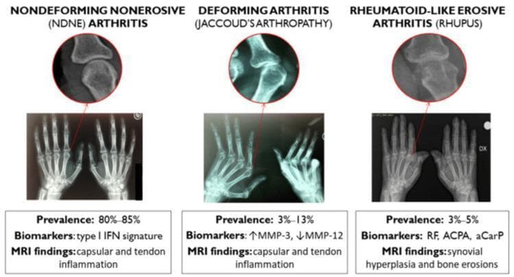 This infographic presents three radiographic patterns of musculoskeletal involvement in systemic lupus erythematosus (SLE). Each section includes a full hand X-ray, a magnified view of a metacarpophalangeal (MCP) or interphalangeal joint, and summary text on prevalence, biomarkers, and MRI findings. 1) Non-deforming Non-erosive (NDNE) Arthritis: Shows normal joint space and alignment without cortical irregularities. Prevalence is 80-85%, associated with a type I IFN signature and capsular/tendon inflammation on MRI. 2) Deforming Arthritis (Jaccoud’s Arthropathy): Demonstrates significant ulnar deviation and joint subluxation but lacks intrinsic bone erosions. Prevalence is 3-13%, associated with elevated MMP-3 and reduced MMP-12. 3) Rheumatoid-like Erosive Arthritis (Rhupus): Characterized by overt marginal bone erosions and joint space narrowing, similar to rheumatoid arthritis. Prevalence is 3-5%, associated with RF, ACPA, and aCarP biomarkers, with MRI showing synovial hyperplasia and bone erosions. This comparison illustrates the spectrum from reversible soft-tissue-mediated deformity to irreversible erosive bone damage in SLE patients.