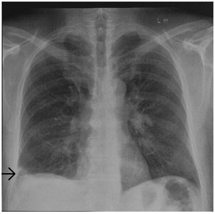 This diagnostic image is a posterior-anterior (PA) chest radiograph. The primary finding is a focal, wedge-shaped area of increased opacity located in the periphery of the right lower lung field, situated just above the diaphragm and abutting the pleura. This radiographic sign, known as a Hampton’s hump, is characterized by its rounded apex pointing toward the hilum and its broad base against the pleural surface, classically indicating pulmonary infarction secondary to pulmonary embolism. The rest of the lung fields appear largely clear with normal lucency and branching pulmonary vasculature. The cardiac silhouette is centrally located and of normal size. Bony structures, including the ribs and clavicles, are intact, and the costophrenic angles are well-visualized. The trachea is midline, and the diaphragmatic contours are sharp, except where the right-sided consolidation overlaps the lateral basal segment. This image serves as a key educational example of a specific radiographic sign associated with vascular pulmonary pathology and is suitable for teaching diagnostic radiology and emergency medicine triage.
