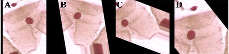 This medical image displays four panels (A, B, C, and D) illustrating Pap smear cytology samples from the Herlev database, used for medical machine learning research. The original clinical photograph (A) shows a single cervical cell with a distinct, darkly stained, round red nucleus and a surrounding lighter pink cytoplasm. Panels B, C, and D demonstrate various data augmentation techniques applied to the original image to improve neural network training. These include geometric transformations such as horizontal and vertical shifts, rotation, zooming, and shearing. There are also visible modifications in color saturation. These panels are used to teach computer vision models to recognize cellular features regardless of orientation or positioning, which is critical for the automated screening of cervical cancer and identifying dysplastic changes in columnar cells.