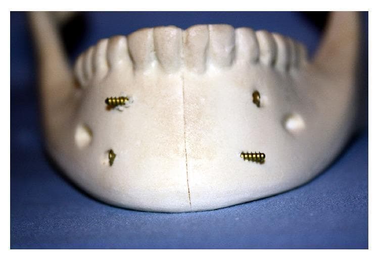 This clinical photograph of a synthetic mandible model demonstrates the internal fixation of a symphyseal/parasymphyseal fracture using the lag screw (LS) technique. A vertical fracture line is visible through the midline of the mandibular symphysis. Stability is achieved using two parallel, self-tapping lag screws placed across the fracture line. The superior screw is inserted from the anatomical left side, while the inferior screw is inserted from the anatomical right side, creating a cross-fixation pattern intended to provide compression and resist torsional forces. The fractured segments show anatomical reduction with close approximation and apposition, and the dental arch appears correctly aligned. This model illustrates a specific osteosynthesis method used in oral and maxillofacial surgery to manage mandibular trauma by providing rigid internal fixation without the need for spanning plates.
