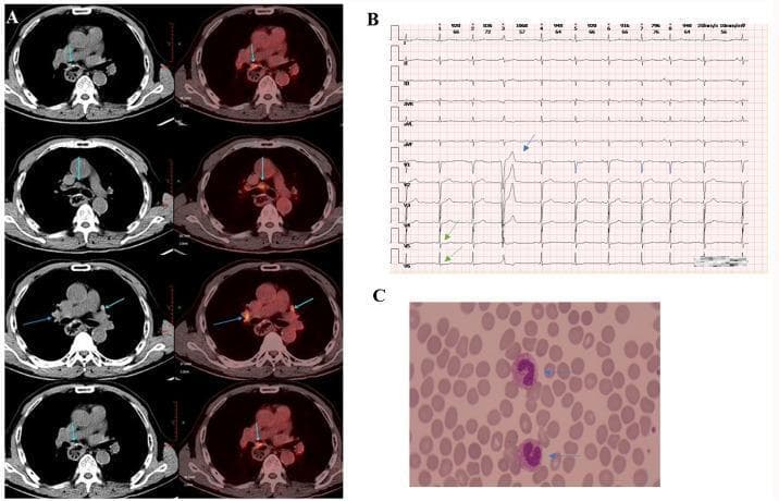 A multi-panel figure containing diagnostic imaging, an electrocardiogram (ECG), and a blood smear. Panel A presents axial PET/CT fusion and CT images of the thoracic and upper abdominal regions, showing a soft tissue mass near the esophageal hiatus and retroperitoneal abdominal trunk with hypermetabolic fluorodeoxyglucose (FDG) uptake, indicating tumor recurrence or metastasis. Panel B displays a 12-lead ECG strip demonstrating arrhythmias including premature atrial contractions (PACs) and premature ventricular contractions (PVCs). Green arrows highlight mild ST-segment depression in leads V5 and V6, while the blue arrow points to significant T-wave morphology changes, suggesting immunotherapy-related myocardial injury. Panel C is a peripheral blood smear micrograph showing two neutrophils with a left shift in nuclei (indicated by blue arrows), characterized by immature band forms, which is suggestive of an acute inflammatory response or infection. This composite illustrates the clinical monitoring of a patient with esophageal squamous cell carcinoma experiencing immune-related adverse events.