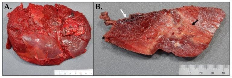 Gross anatomical specimens of a human spleen demonstrating spontaneous rupture and underlying amyloidosis. (A) External view of the splenic capsule, exhibiting a dark red, congested appearance with significant surface irregularities. A large longitudinal posterior laceration (approximately 13.5 cm) is visible, indicative of splenic rupture, along with multiple fibrous adhesions. (B) A cut section of the same spleen reveals heterogeneous parenchyma. A superior subcapsular hemorrhagic zone, measuring approximately 10.5 x 7 x 4 cm, is identified by a white arrow and covered by a thin, tan rind. Additionally, multiple ill-defined, firm, white-yellow infiltrative areas (black arrow) occupy roughly 10% of the cut surface, representing amyloid deposition. The remaining parenchyma is firm and dark red. These images illustrate the gross pathology of amyloid-related splenic friability leading to spontaneous rupture and hematoma formation. Targeted educational concepts include gross organ pathology, hematologic complications of amyloidosis, and surgical specimen evaluation in splenectomy.