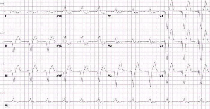 A 12-lead electrocardiogram (ECG) demonstrating a ventricular paced rhythm with a Right Bundle Branch Block (RBBB) morphology, indicative of inadvertent endocardial left ventricular (LV) lead placement. Visible pacing spikes precede each wide QRS complex. The QRS morphology in the precordial leads shows a transition from predominantly negative complexes in V1-V2 to tall, positive R-waves in leads V4-V6. Specifically, V1 displays a broad, slurred complex with terminal positivity, while V4-V6 exhibit prominent R-waves followed by minor secondary deflections. Secondary ST-T wave changes are present, including T-wave inversion in V1-V2 and upright T-waves in V4-V6 and the inferior leads (II, III, aVF). Minor ST-segment depression is noted in the lateral leads (V5-V6). This educational visual highlights the clinical significance of paced RBBB patterns in diagnosing lead malposition via an atrial septal defect into the left ventricle, which contrasts with the expected Left Bundle Branch Block (LBBB) pattern typically seen with right ventricular pacing.