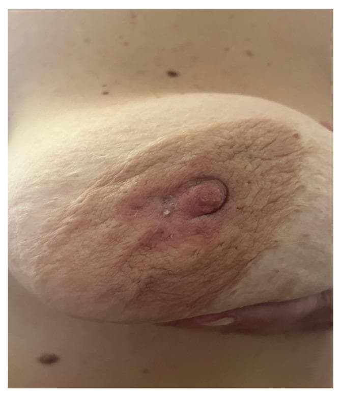 This clinical photograph shows a close-up view of a female breast during a clinical examination, demonstrating significant indicators of breast malignancy. The primary visual findings include marked nipple retraction (inversion), where the nipple is pulled inward toward the breast tissue. The surrounding areola and periareolar skin exhibit extensive epidermal infiltration, characterized by a thickened, erythematous, and 'peau d'orange' (orange peel) texture. The skin appears indurated and leathery, with visible wrinkling and crusting near the nipple-areolar complex. These features are classic clinical signs of advanced or inflammatory breast cancer, where tumor infiltration of the Cooper's ligaments and the dermal lymphatic system leads to tethering and edema. The photograph serves as an educational example of the utility of Clinical Breast Examination (CBE) in identifying physical symptoms like skin dimpling, tethering, and nipple displacement which necessitate further diagnostic imaging such as mammography or ultrasound.