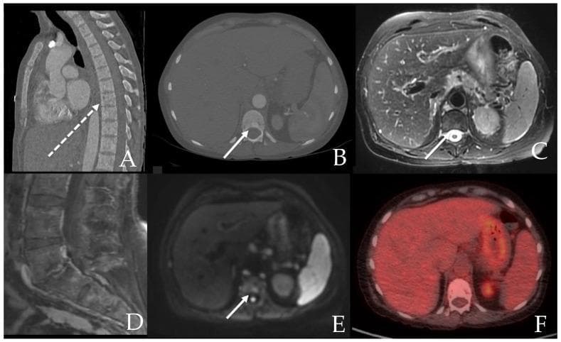A multi-panel diagnostic imaging series demonstrating skeletal manifestations of aggressive systemic mastocytosis in a 71-year-old female. Panel A shows a sagittal CT of the spine revealing diffuse, patchy sclerosis interspersed with focal lytic lesions (dashed arrow). Panel B (axial CT) highlights a specific hyperdense sclerotic lesion in a vertebral body (arrow). Corresponding axial MRIs show this lesion is mildly hyperintense on T2-weighted imaging (C) and Diffusion-Weighted Imaging (E), suggesting increased cellularity or marrow edema. Panel D depicts a sagittal post-contrast T1-weighted MRI with mild, variable enhancement across the vertebral segments. Panel F shows a fused PET/CT scan demonstrating that the sclerotic bone lesions are non-PET hypermetabolic. The collection serves as a clinical comparison of CT, MRI (T1, T2, DWI), and PET modalities in evaluating heterogeneous (mixed lytic and sclerotic) bone marrow involvement associated with mast cell disorders.