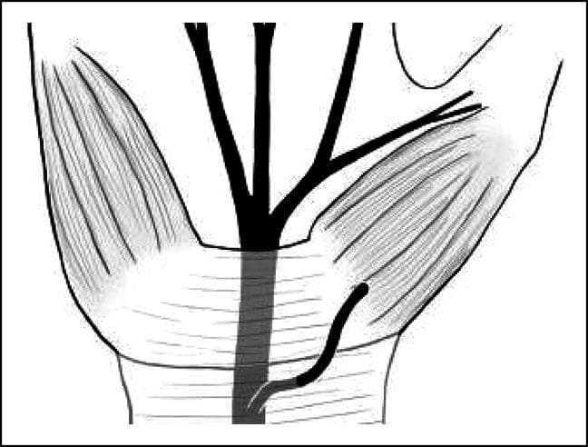 This medical anatomical diagram illustrates a rare variation of the hand's neurovasculature, specifically the preligamentous course of the thenar motor branch (TMB) of the median nerve. The black-and-white line drawing shows the median nerve trunk passing deep to the transverse carpal ligament (TCL). In this variation, the thenar motor branch originates from the median nerve proximal to the carpal tunnel and courses superficially over the transverse carpal ligament before diving into the striated thenar musculature on the radial side of the palm. The illustration highlights critical surgical anatomy for procedures such as carpal tunnel release, where identifying the TMB's relationship to the TCL is essential to avoid iatrogenic injury. The diagram provides educational context for understanding anatomical deviations that do not strictly adhere to standard classifications like the Lanz system, specifically demonstrating an 'over the ligament' pathway rather than the typical subligamentous or transligamentous routes.