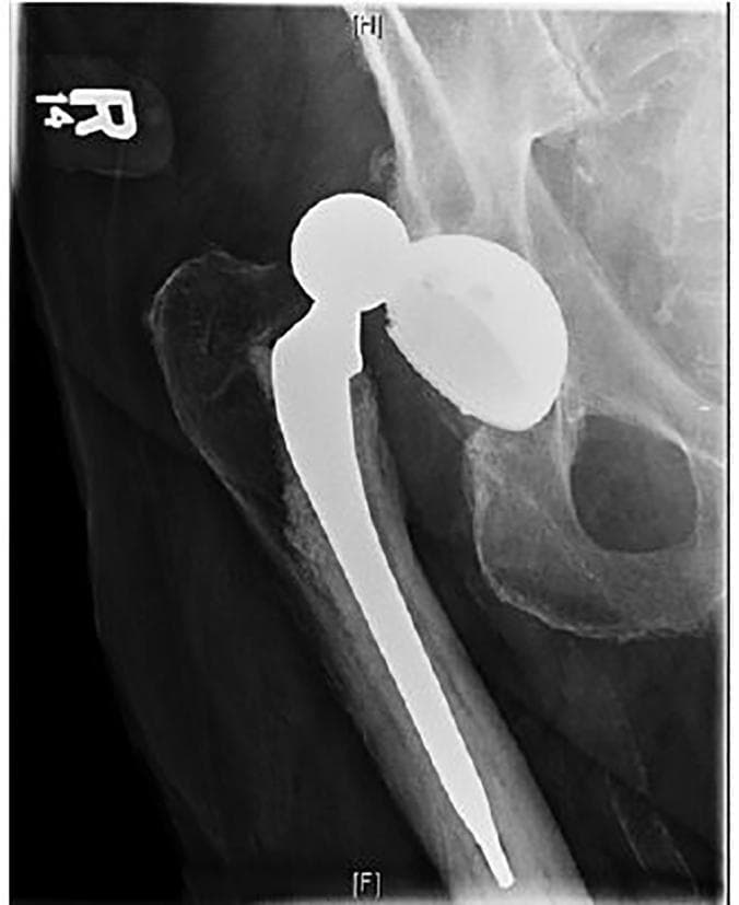 Anterior-posterior (AP) radiograph of the right hip demonstrating a total hip arthroplasty (THA) with superior dislocation. The image shows the radio-dense prosthetic components: a hemispherical acetabular cup seated within the ilium and a femoral component consisting of a metallic stem and a spherical femoral head. The femoral head is positioned entirely outside the acetabular cup, displaced superiorly toward the iliac wing, indicating a complete prosthetic joint dislocation. The femoral stem remains properly seated within the medullary canal of the proximal femur. No acute periprosthetic fractures are immediately evident. This diagnostic image illustrates a common orthopedic complication post-hip replacement, requiring clinical intervention for joint reduction. Anatomical landmarks include the pelvis, specifically the acetabulum and obturator foramen, and the proximal femur with the greater and lesser trochanters.