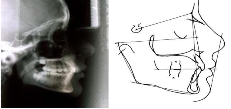 This diagnostic and comparison image consists of a lateral cephalometric radiograph (left) and a corresponding anatomical tracing (right) illustrating craniofacial morphology. The radiograph shows a lateral view of the human skull, detailing the cranial vault, sella turcica, facial bones, maxilla, mandible, and dental occlusion. The accompanying cephalometric diagram outlines key landmarks and planes used in orthodontic and maxillofacial surgery analysis, including the SN plane, mandibular plane, and soft tissue profile (nose, lips, and chin). The image specifically demonstrates an 'anterior rotation type' growth pattern, highlighting the relationship between skeletal bases and dental alignment. This material is designed for intermediate to advanced dental education, focusing on orthodontics and cephalometry to assess jaw discrepancies and facial growth vectors.
