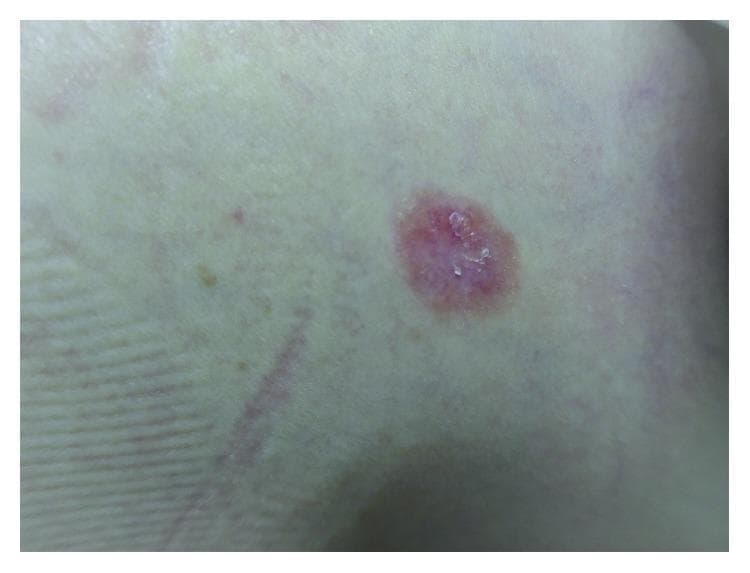 A clinical photograph of a localized skin lesion on the chest, identified as psoriasis in a patient with psoriatic arthritis. The image shows a well-circumscribed, oval-shaped erythematous plaque with a reddish-pink hue. The surface of the lesion exhibits fine, silvery-white scales and slight crusting, consistent with hyperkeratosis and parakeratosis. The lesion is slightly elevated above the level of the surrounding healthy skin. The borders are moderately defined but irregular, blending into the adjacent integument. The surrounding skin appears normal with natural dermatoglyphic patterns and a minor linear abrasion nearby. This image demonstrates the typical cutaneous manifestation of psoriasis, which serves as a critical diagnostic marker for differentiating types of inflammatory arthropathies, such as arthritis mutilans.