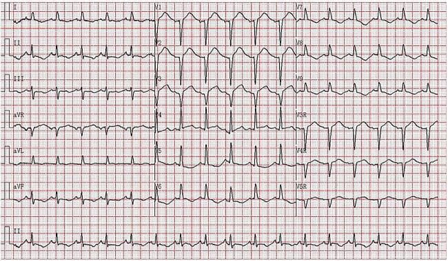 A 12-lead electrocardiogram (ECG) with additional posterior and right-sided leads (V7-V9 and V3R-V5R) displaying sinus tachycardia at approximately 103 bpm. The tracing exhibits significant ST-segment and T-wave abnormalities. Key findings include ST-segment elevation in the anterior precordial leads V1-V4, with a predominantly negative (r)QS morphology in V1-V3. Concurrently, there is evidence of ST-segment depression and deep T-wave inversion in the inferior leads (II, III, aVF) and the lateral/posterior leads (V5-V9). The QRS complexes in the lateral leads V5-V6 appear wide with associated repolarization changes. These visual features are characteristic of acute myocardial injury or ischemia patterns, such as those seen in ST-elevation myocardial infarction (STEMI) or catecholamine-induced cardiomyopathy. The tracing is presented on standard grid paper for clinical diagnostic evaluation of cardiac rhythm and morphology.