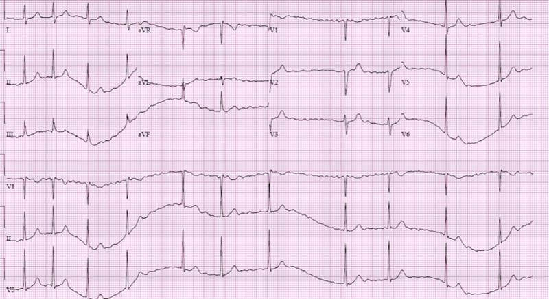 This diagnostic image is a 12-lead electrocardiogram (ECG) printed on standard pink grid paper, demonstrating a classic presentation of atrial fibrillation (AF). The primary finding is an irregularly irregular rhythm, characterized by varying R-R intervals across all leads. There is a complete absence of discernible, organized P waves; instead, the baseline shows fine, fibrillatory oscillations, most visible in leads V1 and II. The ventricular rate is controlled (normal rate), suggesting this is not a rapid ventricular response (RVR) at this moment. The QRS complexes are narrow, indicating normal intraventricular conduction. T waves in the precordial leads (V1-V6) show varied morphologies, including some flattening or inversion, particularly in V1-V3, while ST segments remain relatively isoelectric without acute elevations or depressions. This ECG is representative of common cardiac dysrhythmias and serves as a teaching tool for recognizing disorganized atrial activity and irregular ventricular conduction in clinical cardiology.