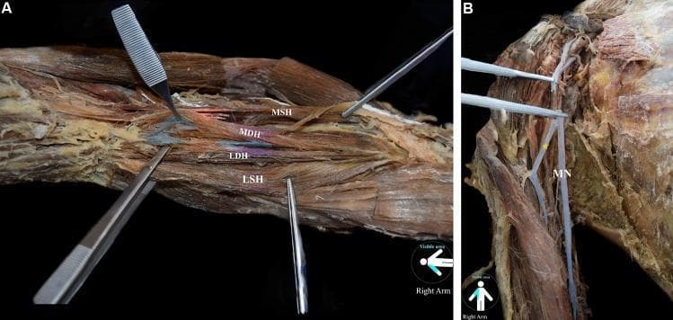 Anatomical dissection of a right upper limb demonstrating a four-headed variant of the brachialis muscle and associated neural supply. Panel A shows the gross morphology of the brachialis muscle, subdivided into four distinct bellies: the main superficial head (MSH), main deep head (MDH), lateral superficial head (LSH), and lateral deep head (LDH). The bellies exhibit a light tan color with clear longitudinal striations and are retracted with surgical instruments to show their relative deep-to-superficial layering. Panel B illustrates the innervation pattern in the absence of the musculocutaneous nerve. The median nerve (MN), depicted as a white, linear trunk, is shown providing atypical muscular branches (marked with an asterisk) to the anterior compartment of the arm. This clinical image highlights rare anatomical variations in upper limb myology and neurovascular architecture, emphasizing the surgical significance of identifying accessory muscle heads and variant motor innervation from the median nerve during orthopedic or neurosurgical procedures.