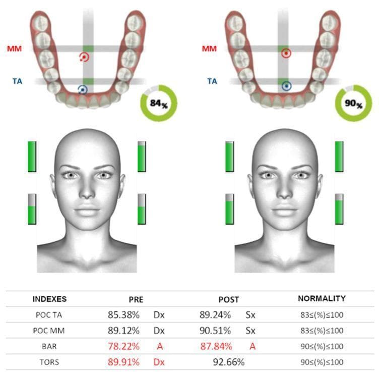 A comparison infographic displaying surface electromyography (sEMG) data for dental occlusion assessment, comparing 'PRE' and 'POST' intervention states. The visual is divided into four main sections: occlusal board graphics, global balance percentages, facial muscle activation indicators, and a quantitative index table. The occlusal board diagrams illustrate the dental arch with target points for the Masseter (MM) and Temporalis Anterior (TA) muscles. Flanking a 3D facial avatar are green vertical bar graphs representing the intensity of muscle contraction for the masseter and temporalis muscles bilaterally. A circular gauge shows a global neuromuscular balance score, which increases from 84% (PRE) to 90% (POST). The bottom table details functional indices including POC TA (Percentage Overlap Coefficient for Temporalis Anterior), POC MM (Masseter), BAR (Barycenter), and TORS (Torsion). Values highlighted in red, such as the initial BAR at 78.22%, indicate measurements falling outside the 'Normality' range (defined as 83-100% or 90-100% depending on the index). The image demonstrates clinical improvement in cranial neuromuscular symmetry and occlusal stability following treatment.