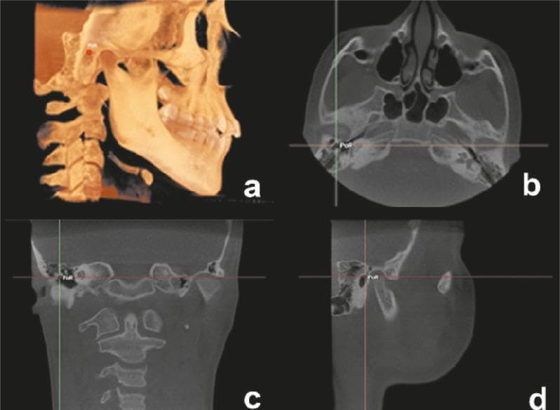 Diagnostic imaging composite showcasing multiplanar reconstructions (MPR) of a human skull derived from Cone Beam Computed Tomography (CBCT). View A is a 3D volume rendering displaying a lateral perspective of the craniofacial skeleton, including the mandible and cervical vertebrae, with the Porion (PoR) cephalometric landmark marked by a red point. View B presents an axial section at the level of the skull base, showing the sphenoid sinuses, nasal cavity, and petrous part of the temporal bones. View C is a coronal reconstruction showing the craniovertebral junction and mastoid processes. View D is a sagittal section demonstrating the temporomandibular joint area and the profile of the facial soft tissues. In views B, C, and D, the PoR landmark is precisely localized at the intersection of orthodontic crosshairs, specifically identifying the most superior point of the external auditory meatus. This visualization is used in dental and maxillofacial surgery for cephalometric analysis, symmetry assessment, and surgical planning.
