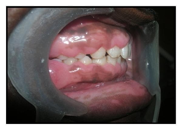This intraoral clinical photograph, taken from a lateral perspective with a mouth retractor, demonstrates generalized gingival enlargement (gingival fibromatosis). The gingiva appears significantly thickened and bulbous, exhibiting a firm, smooth, and slightly shiny texture that lacks the normal stippled appearance. The tissue enlargement is extensive, migrating coronally and partially obscuring the clinical crowns of both the maxillary and mandibular teeth, which makes the teeth appear abnormally short. The color of the gingiva is predominantly pink, with noticeable areas of physiologic melanin hyperpigmentation presenting as brownish-black patches. The interdental papillae are severely enlarged, filling the embrasures and contributing to the overall bulky and congested appearance of the dental arches. This presentation is characteristic of hereditary gingival fibromatosis, a condition that can interfere with occlusion, speech, and oral hygiene maintenance.