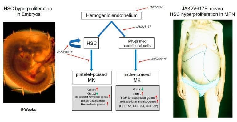 A multi-panel medical illustration comparing normal embryonic development with adult myeloproliferative neoplasms (MPN). On the left, a clinical photograph shows a human embryo at 5 weeks post-conceptus, exhibiting a characteristic C-shape and a prominent reddish liver rudiment, labeled as HSC hyperproliferation in embryos. In the center, a pathophysiology flowchart depicts the differentiation of hemogenic endothelium into hematopoietic stem cells (HSC) and megakaryocyte (MK)-primed endothelial cells. It illustrates how transcription factor balances (Gata1 vs. Gata2) determine the maturation of platelet-poised megakaryocytes versus niche-poised megakaryocytes. The diagram highlights the role of the JAK2V617F mutation in driving self-renewal and lineage-specific hyperproliferation. On the right, a clinical photograph of a patient with MPN demonstrates massive abdominal distension. Blue and red ink markings on the skin outline significant hepatosplenomegaly, representing massive extramedullary hematopoiesis. The visual comparison links embryonic developmental processes to pathological states in adult hematological malignancies, specifically illustrating how mutations in the hemogenic niche drive disease progression.