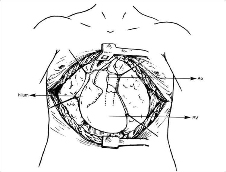 Anatomical diagram and surgical illustration of a 'clamshell' thoracotomy approach (bilateral anterolateral thoracotomy with transverse sternotomy). The diagram depicts a wide surgical field across the anterior chest wall, extending laterally toward the axillary lines. Key mediastinal and thoracic structures are exposed and labeled, including the heart centrally with the right ventricle (RV) prominently visible, and the ascending aorta (Ao) superior to it. The hilum is visible bilaterally, providing access to the pulmonary structures. The image demonstrates the extensive exposure of the anterior and posterior mediastinum provided by this incision, which is commonly utilized in complex cardiothoracic procedures, such as unifocalization of major aortopulmonary collateral arteries (MAPCAs) or lung transplantation, particularly in cases involving significant scarring from previous median sternotomies.