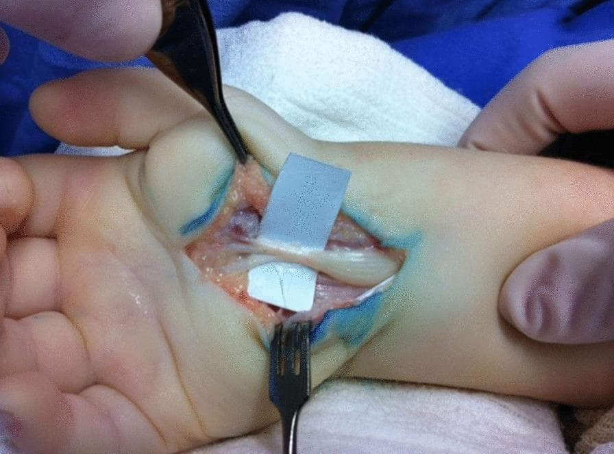 This clinical photograph captures an intraoperative view of a pediatric carpal tunnel release, highlighting severe median nerve compression. The open surgical field at the volar aspect of the wrist reveals a yellowish-white, cord-like median nerve. A hallmark 'hourglass' deformity is clearly visible, where the nerve exhibits a significant, localized narrowing (constriction) at the site of the former transverse carpal ligament, with proximal and distal swelling. The surrounding anatomy includes exposed flexor tendons and subcutaneous fat. Surgical instruments, including a multi-pronged rake retractor and forceps, are positioned to maintain the surgical window. Blue surgical marking ink is visible on the skin edges. The image serves as a classic educational example of chronic nerve entrapment pathology, demonstrating the macroscopic morphological changes resulting from prolonged mechanical compression within the carpal tunnel.