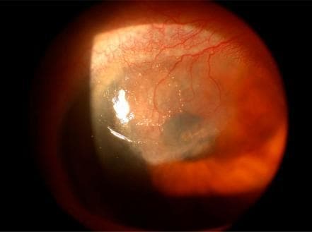 This clinical photograph of a patient's right eye displays intense ocular inflammation and post-surgical complications. The primary findings include significant scleritis or episcleritis characterized by diffuse, deep-seated redness and engorgement of the episcleral and scleral blood vessels, obscuring the normal white appearance of the scleral tissue. The cornea exhibits notable corneal neovascularization, with fine, branching blood vessels invading the peripheral corneal stroma from the limbus. These vascular changes are concentrated adjacent to a visible surgical site, identified as a clear corneal incision typically associated with cataract surgery. The image illustrates educational concepts related to postoperative ophthalmological complications, specifically the inflammatory response and the angiogenic process following intraocular surgery. It serves as a diagnostic reference for identifying severe anterior segment inflammation and pathological vessel growth in a postoperative clinical setting.